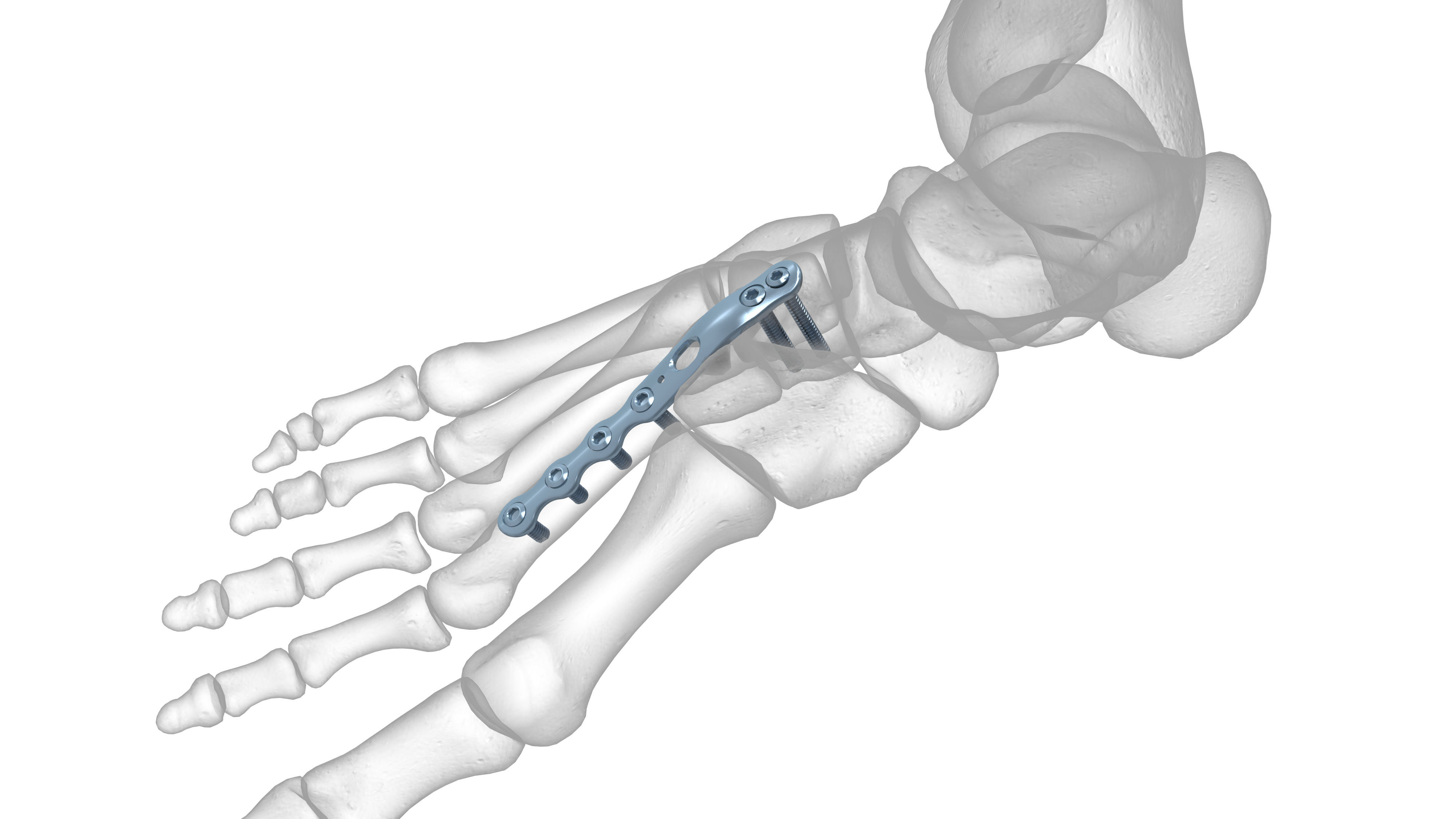 Extended 2nd and 3rd Ray TMT Plate Acumed
